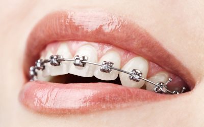 Learning Braces vs. Liners in Dental Hygienist School